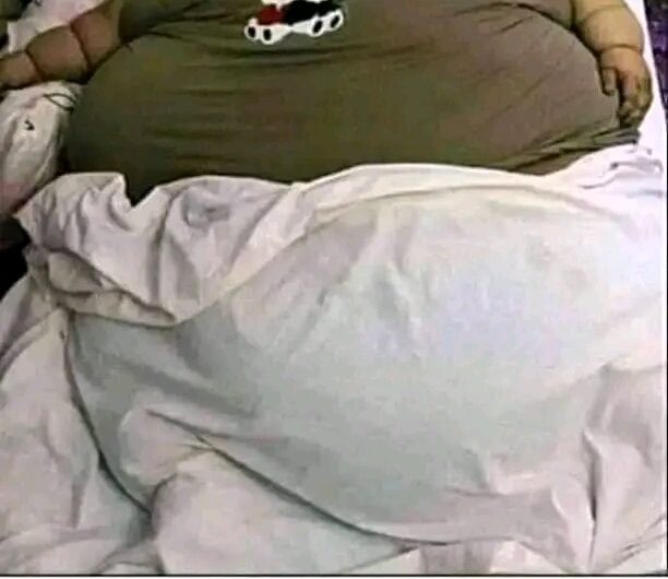Muere la mujer más obesa del mundo tras someterse a un tratamiento de reducción de peso